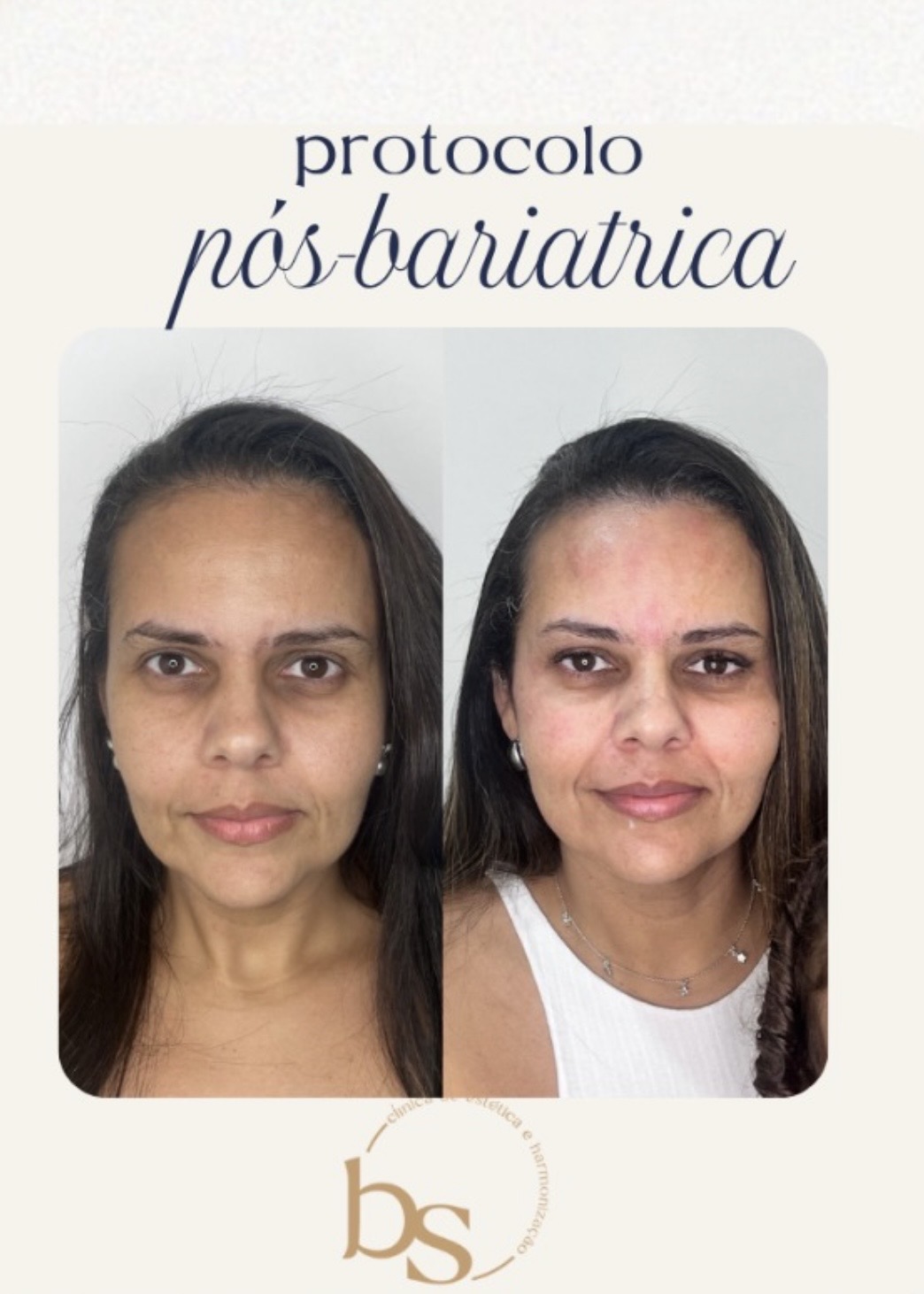 Antes e depois de Protocolo pós-bariátrica