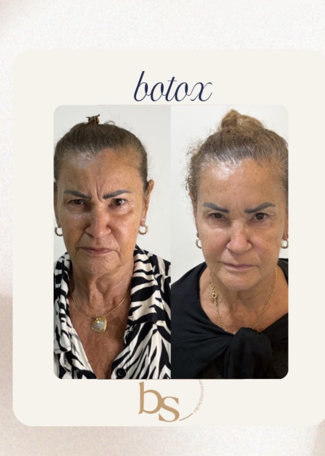 Antes e depois de Botox