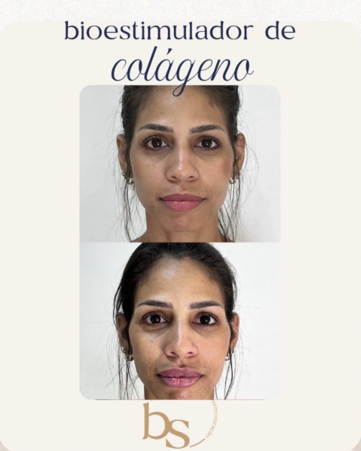 Antes e depois de Bioestimulador de colágeno