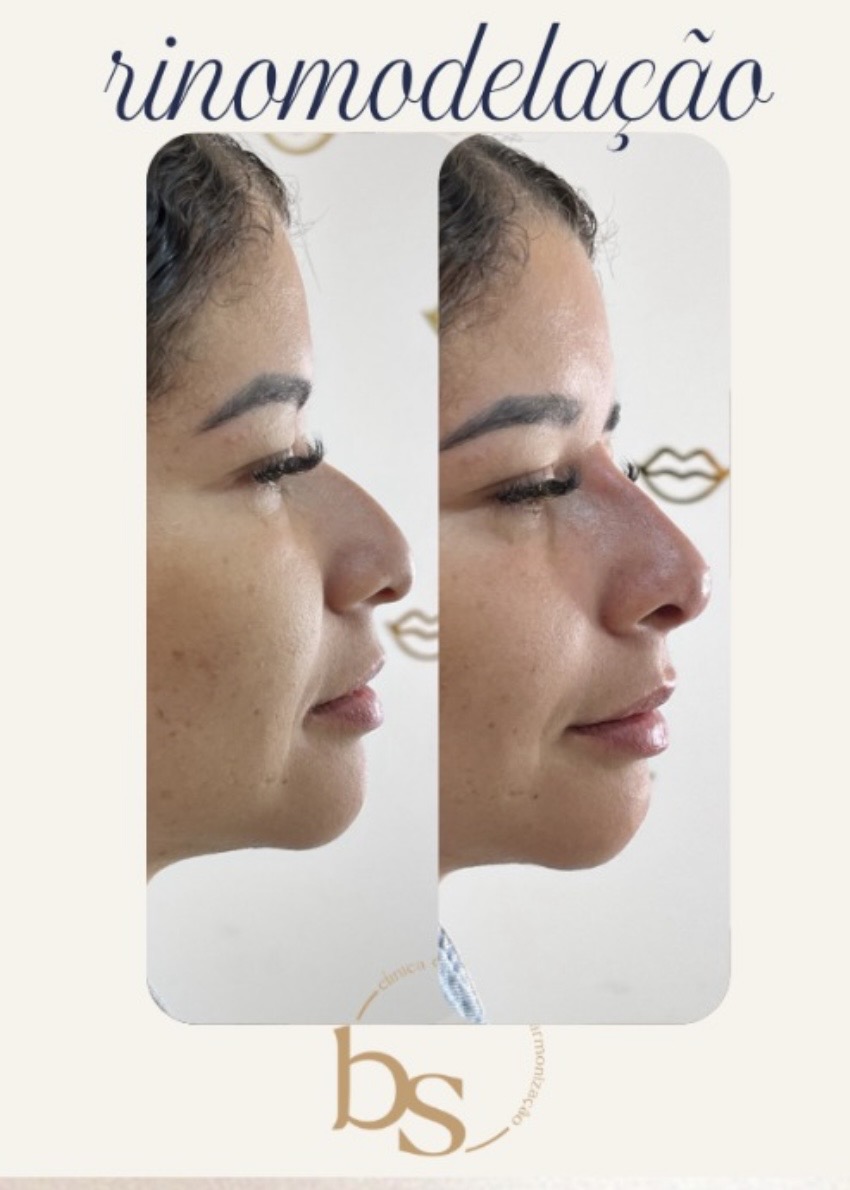 Antes e depois de Rinomodelação