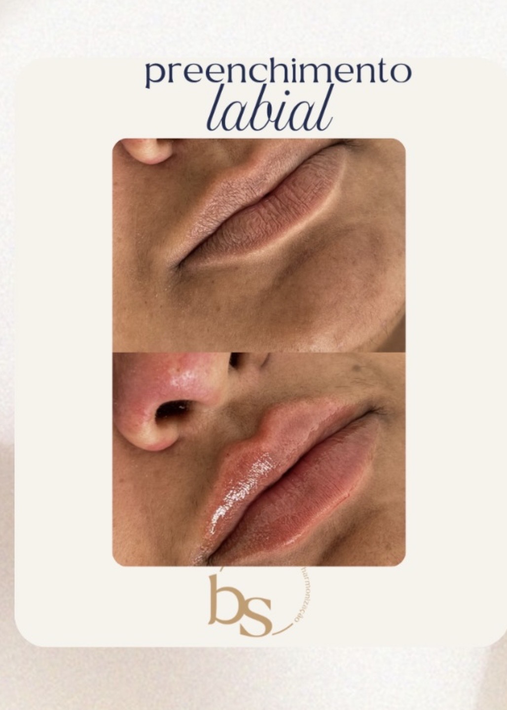 Antes e depois de Preenchimento labial